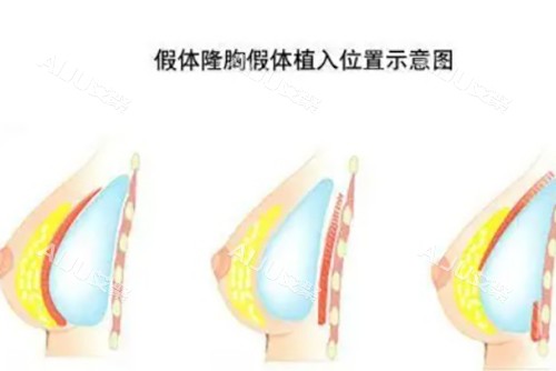 2026重庆丰胸手术价格表：详细对比假体丰胸与自体脂肪丰胸的现行市场价位