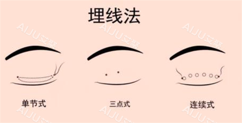 埋线双眼皮经过