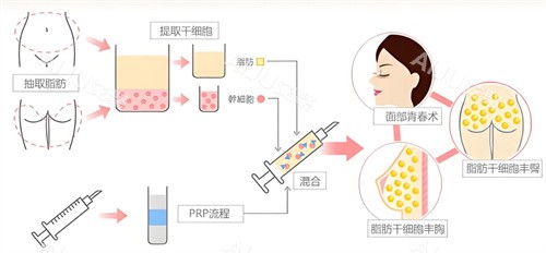 自体脂肪隆胸过程