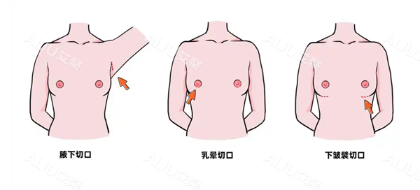 隆胸手术切口图