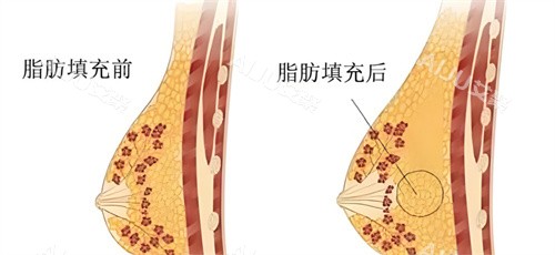 自体脂肪隆胸脂肪对比