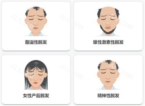 不同脱发类型