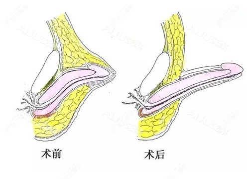 增长增粗手术费用大公开！4W起真实价目表对比，各地价格差异一目了然！