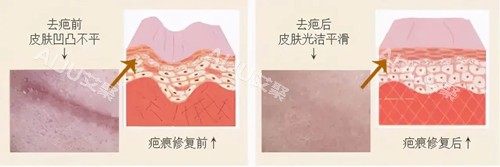 激光祛疤卡通示意图