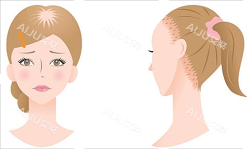 女生脱发类型