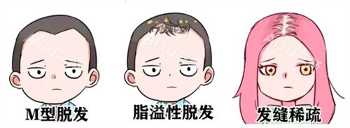 脱发种类