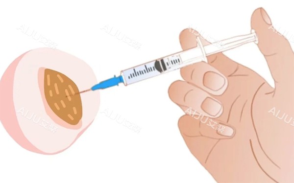 私密注射紧缩针照片
