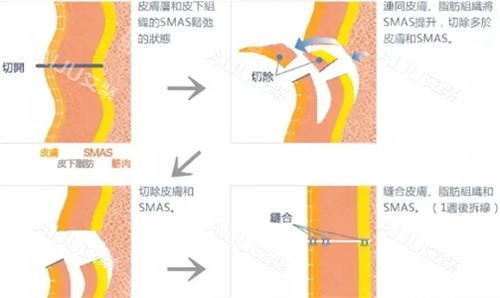 拉皮手术过程 拉皮手术过程