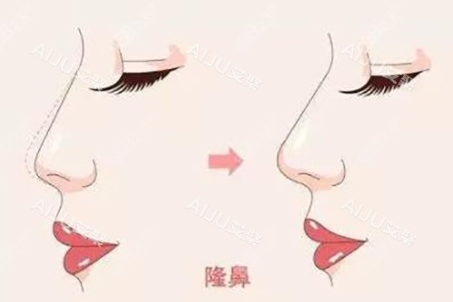 隆鼻对比示意图 隆鼻对比示意图