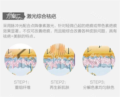 激光祛疤图示