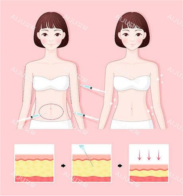 腰腹吸脂对比